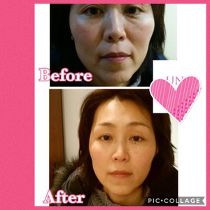 鎌倉 サーモン水光注射