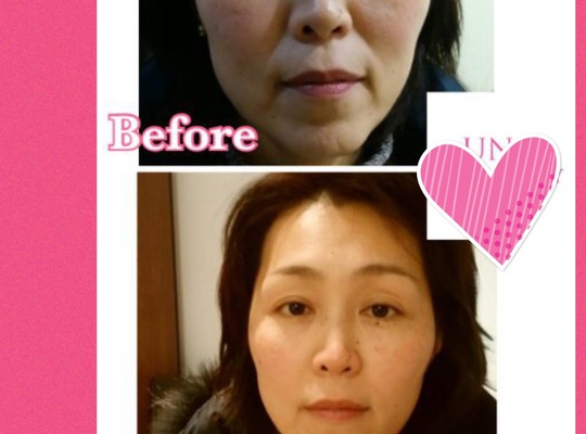 水光注射ビフォーアフター