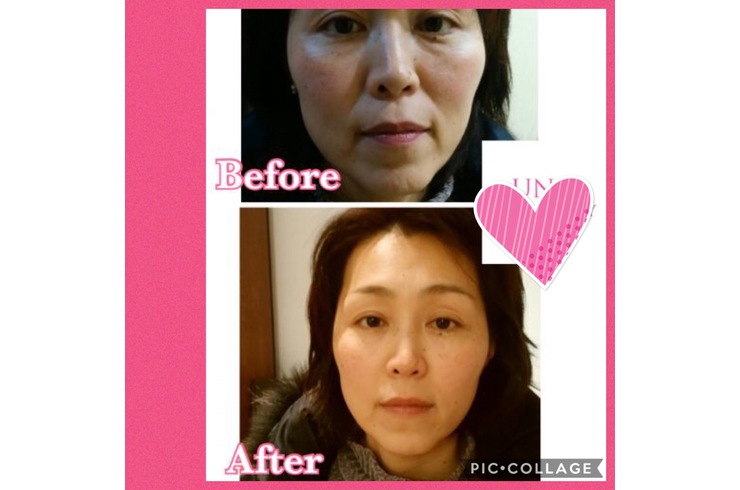 水光注射ビフォーアフター