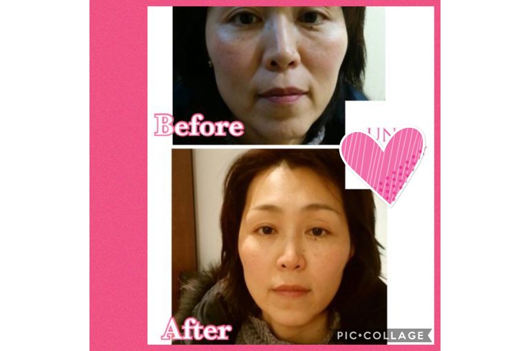 水光注射ビフォーアフター